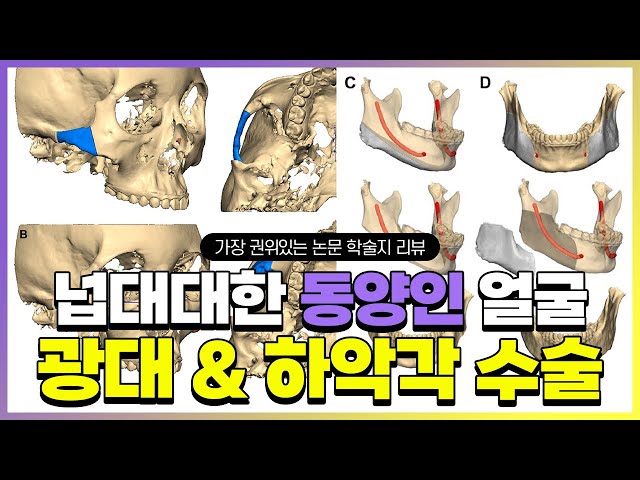 [논문 리뷰] 얼굴이 넓은 동양인의 광대와 사각턱수술