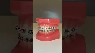 🔴⚫️Braces Color Combination: Red and Black 🔴⚫️ Check out this braces color combo of red and black