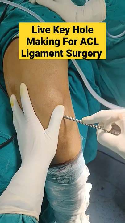 Live Key Hole Making For ACL Ligament Surgery | #aclsurgery #acl #acltear #mbbs #surgeon #doctor |
