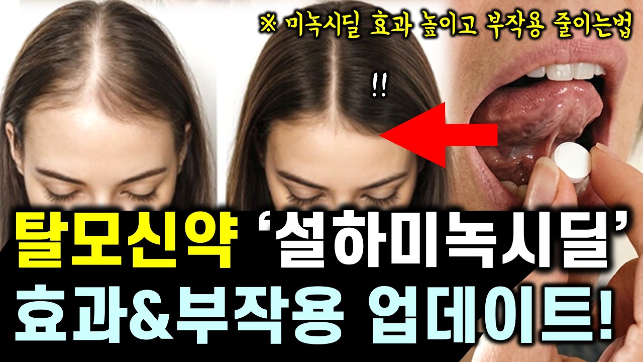 "혀밑에서 녹인다?" 탈모약 미녹시딜 효과 2배 높이고 부작용 줄이는 방법 (feat. 탈모치료 신약 리뷰, 머리카락 굵어지는 방법)