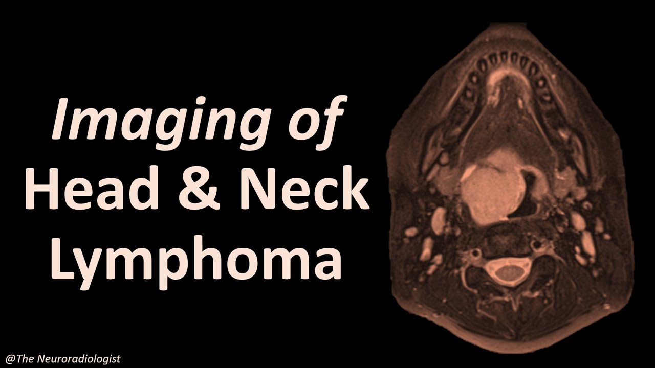 Визуализация лимфомы головы и шеи