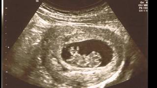 My Pregnancy My First Ultrasound