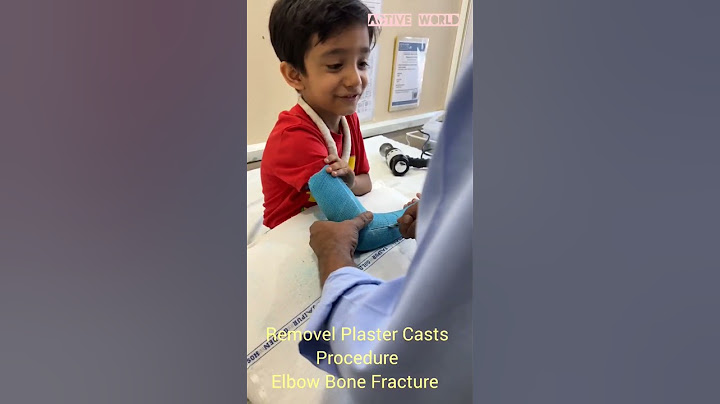 Removel of Plaster Casts Procedure Elbow Bone Fracture #plaster #aacidentnews #facture #bonefracture
