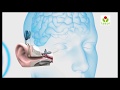Cochlear Implant Surgery | Hearing loss treatment | How cochlear implant(Aud.Tewfiq Siliman Herini - Erbil-Kurdistan)) tewfiqsiliman@yahoo.com 009647504485973...