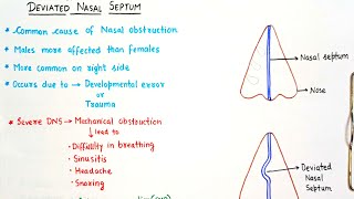 Deviated Nasal Septum