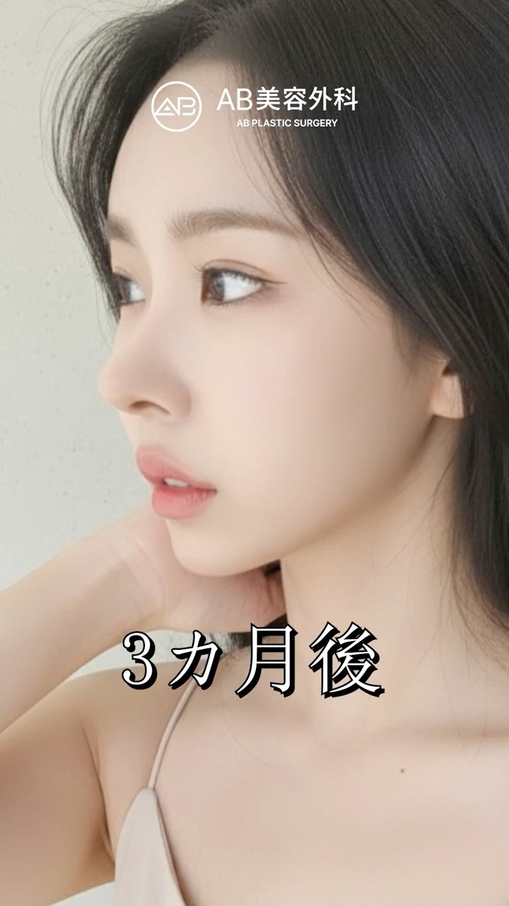 韓国で鼻＋輪郭整形して3ヶ月…自然すぎる変化 #shorts