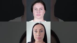 Louise's Facial Rejuvenation Journey — First Look