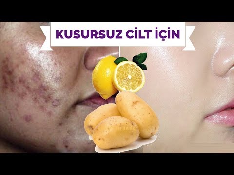 KUSURSUZ CİLT İÇİN LEKE GİDERİCİ YÜZ BEYAZLATICI PATATES LİMON MASKESİ (Tüm Ciltler İçin)