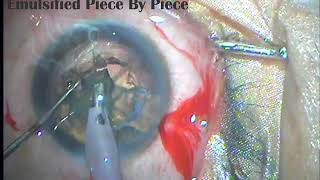soft cataract multifocal Iol Implantation screenshot 4