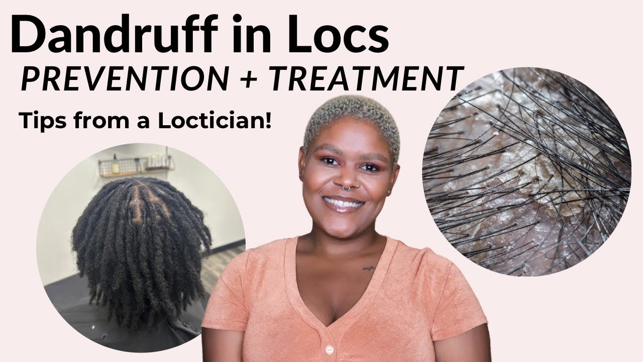 Dandruff + Locs | Loctician Tips, Products, Routines - YouTube