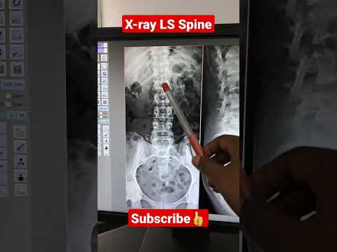 Digital X-ray L-S Spine #shorts