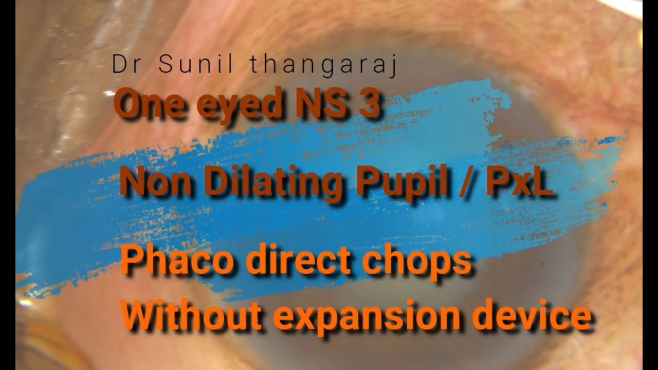 One eyed non dilating pupil pseudoexfoliation zonular laxity Phaco