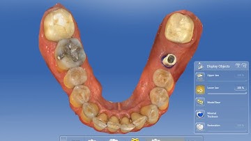 Cerec Atlantis