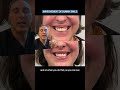 Improvement of Gummy Smile