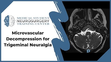 Microvascular Decompression for Trigeminal Neuralgia
