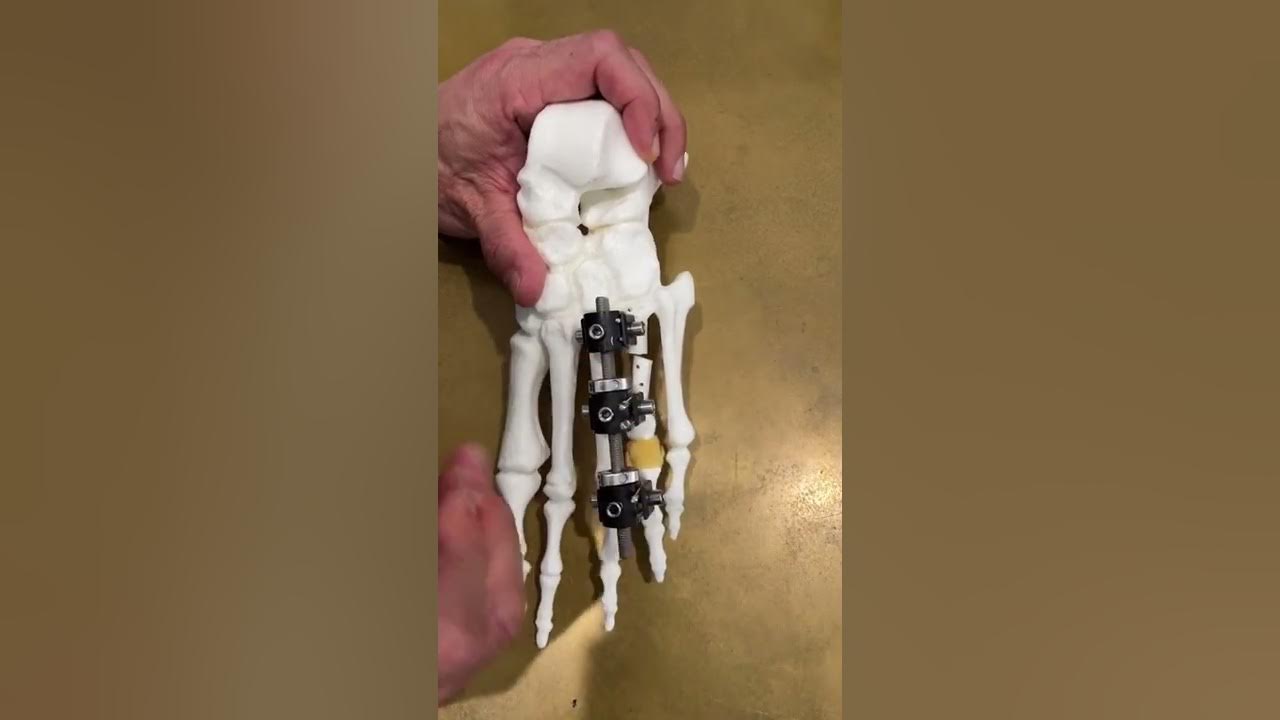 Bone Lengthening Treatment How does it work? YouTube