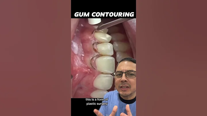 Reshaping the Gums for an Aesthetic Smile | View Mobile Dental #shorts