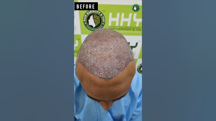 1 YEARS HAIR TRANSPLANT RESULTS #shorts