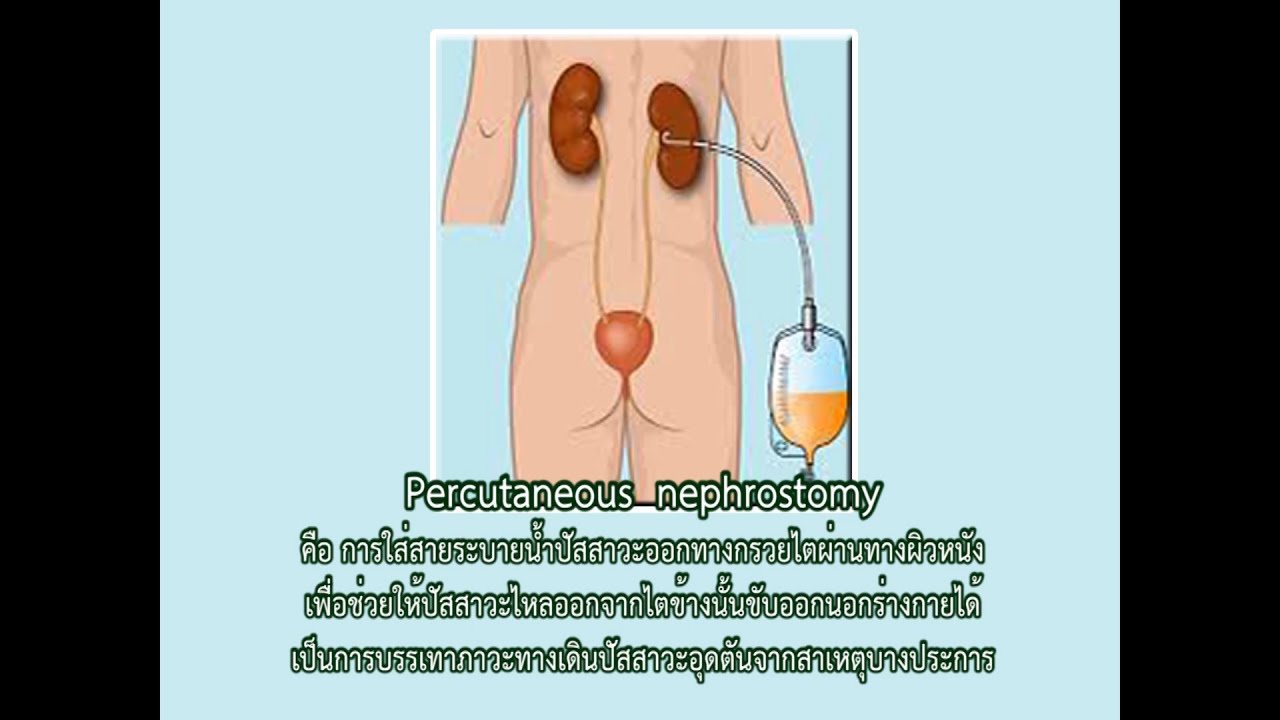 หัตถการเปลี่ยน Percutaneous nephrostomy (PCN) เพื่อเจ้าหน้าที่ และประชาชน