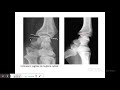 Fractures de lextrmit nfrieure du radius