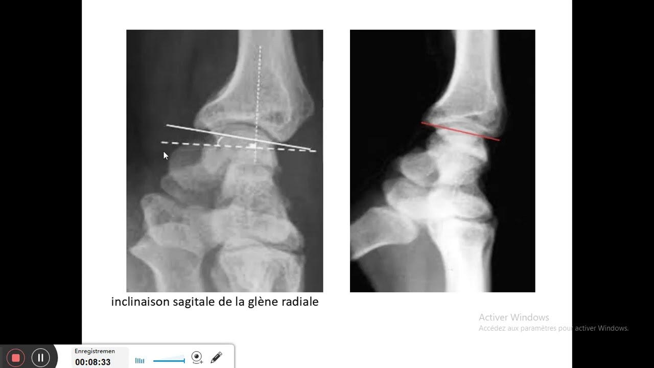 fractures de l'extrémité nférieure du radius