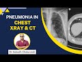 X ray  ct chest type of diseases live