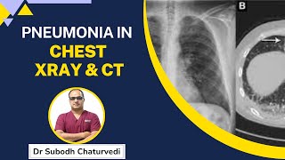 X Ray  CT Chest Type of Diseases LIVE