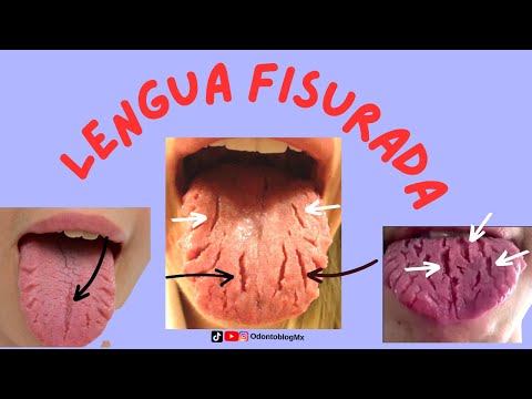 Lengua fisurada ó