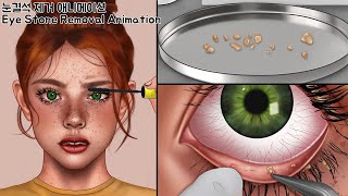 ASMR Eye Stone Removal Clogged by Old Mascara & Dirty Contact Lenses!