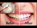 Diy teeth whitening at home in 2 minutes