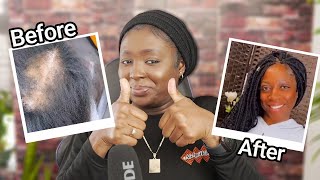 another Epic Alopecia Transformation