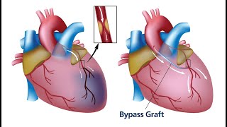 CPT code for bypass graft with vein - simplify medical coding