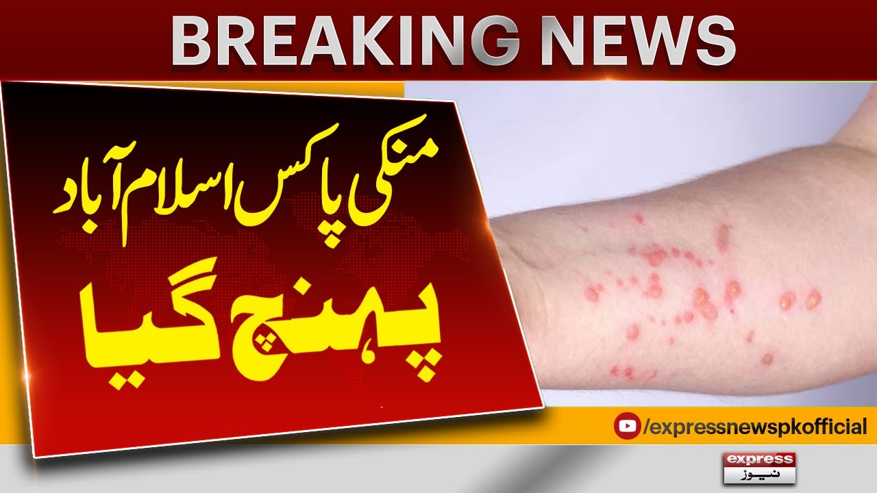 First Case Of Monkeypox Confirmed In Islamabad | Pakistan News | Latest ...