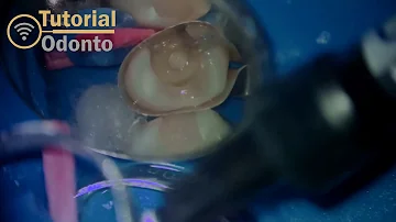 Como restaurar um dente com canal?