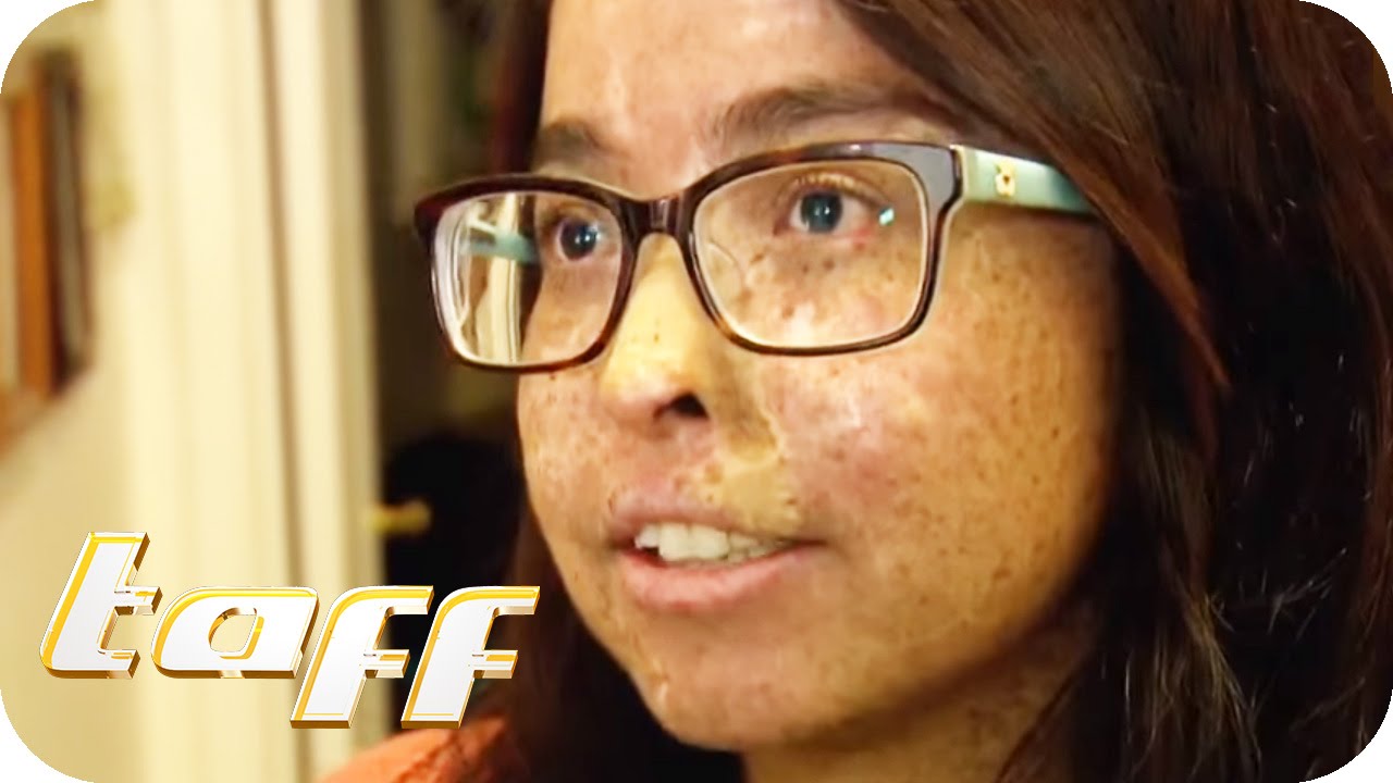 Leben in Dunkelheit: Menschen mit Xeroderma pigmentosum | taff