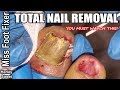 Permanent Toenail Removal Painlessly Within FIVE Minutes By Miss Foot Fixer Marion Yau