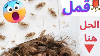 اليك الحل للتخلص من القمل نهائيا Get rid of lice