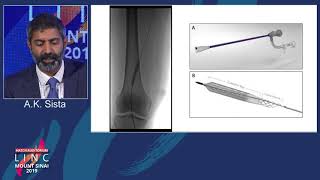 Hatch D1 - Mechanical Thrombectomy: What are the Options? - Dr. Sista
