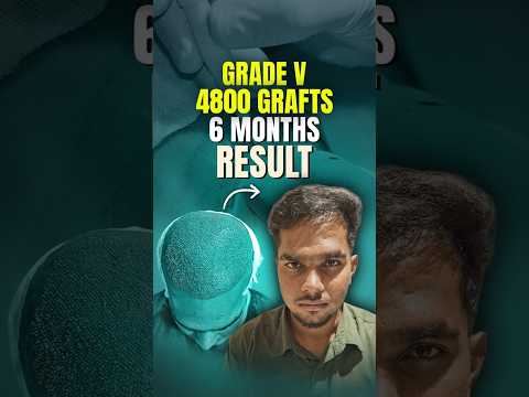 Hair Transplant Result in 6 Months | 4800 Grafts | Bangalore #hairtransplant #shorts