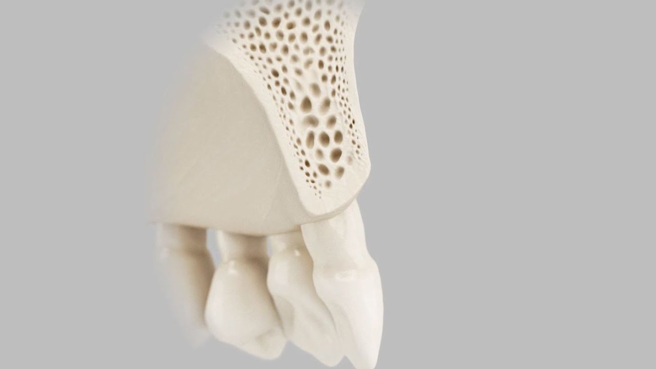 Bone remodeling and implant placement options in sloped ridge YouTube