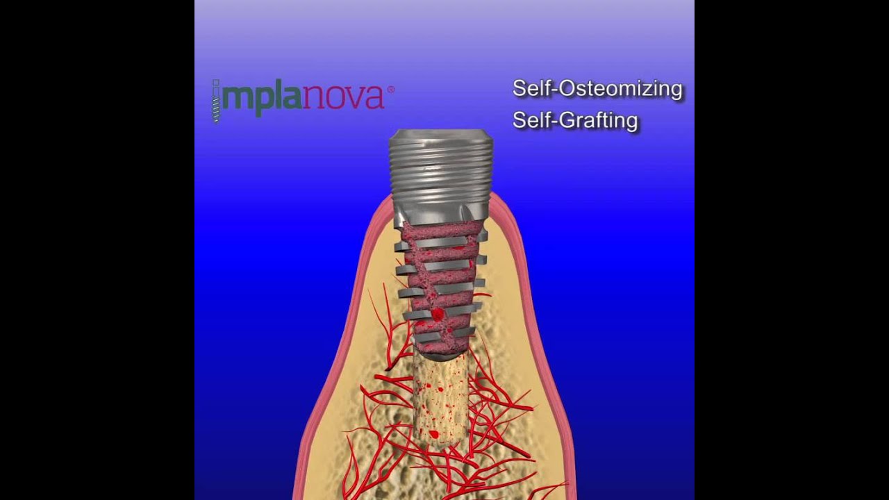 Implanova: Self-Grafting Dental Implant System