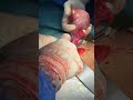 Adnexectomy easiest procedure no bledding