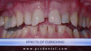 Ask Gordon What Is The Difference Between Bruxism And Clenching?