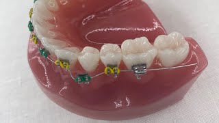 BROKEN BRACKET NEAR FRONT OR MIDDLE OF MOUTH At Home Solutions
