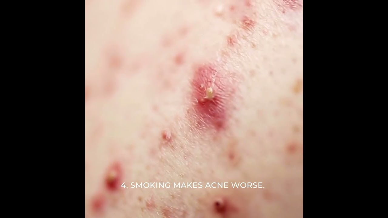 5 striking effects of smoking on your skin -   Dr Hiba Injibar, Dermasurge Clinic