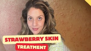 Strawberry Skin Treatment | Keratosis Pilaris Treatment at Home | Top body shaving mistakes