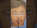 टेढ़ी नाक क्या होती है  ##drsuniltanvar #dns #crookednose #deviatedseptum