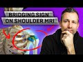 The Bridging Sign In Rotator Cuff Tears on Shoulder MRI