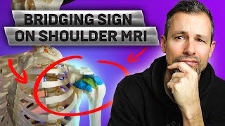 The Bridging Sign In Rotator Cuff Tears on Shoulder MRI