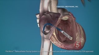 Celebrity Mini Pacemaker Has No Wires Profile